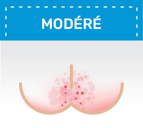 illustration d'un érythème fessier modéré