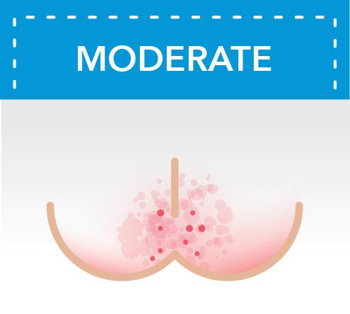 moderate diaper rash on bottom