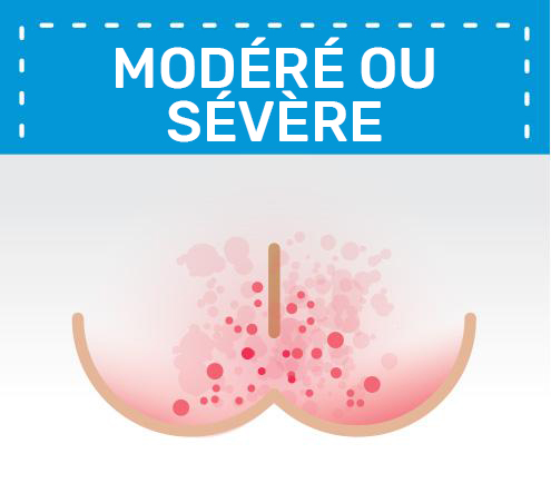 illustration d'un érythème fessier modéré ou sévère