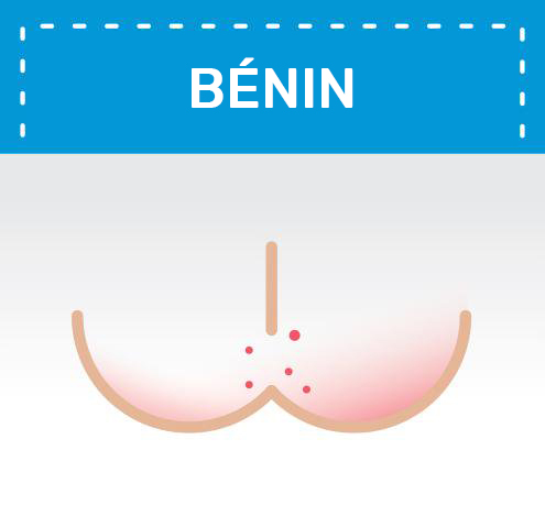 illustration d'un érythème fessier bénin