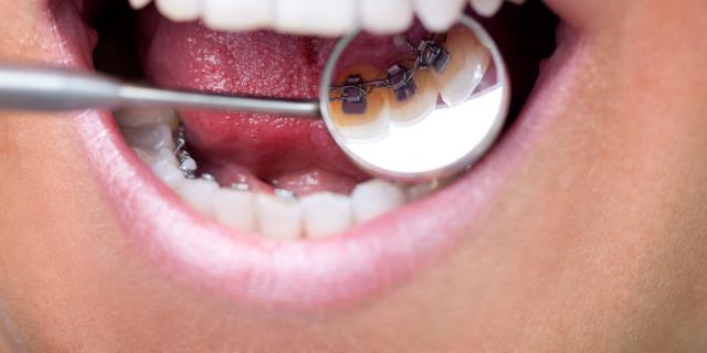 L’appareil dentaire lingual : prix, remboursement et efficacité