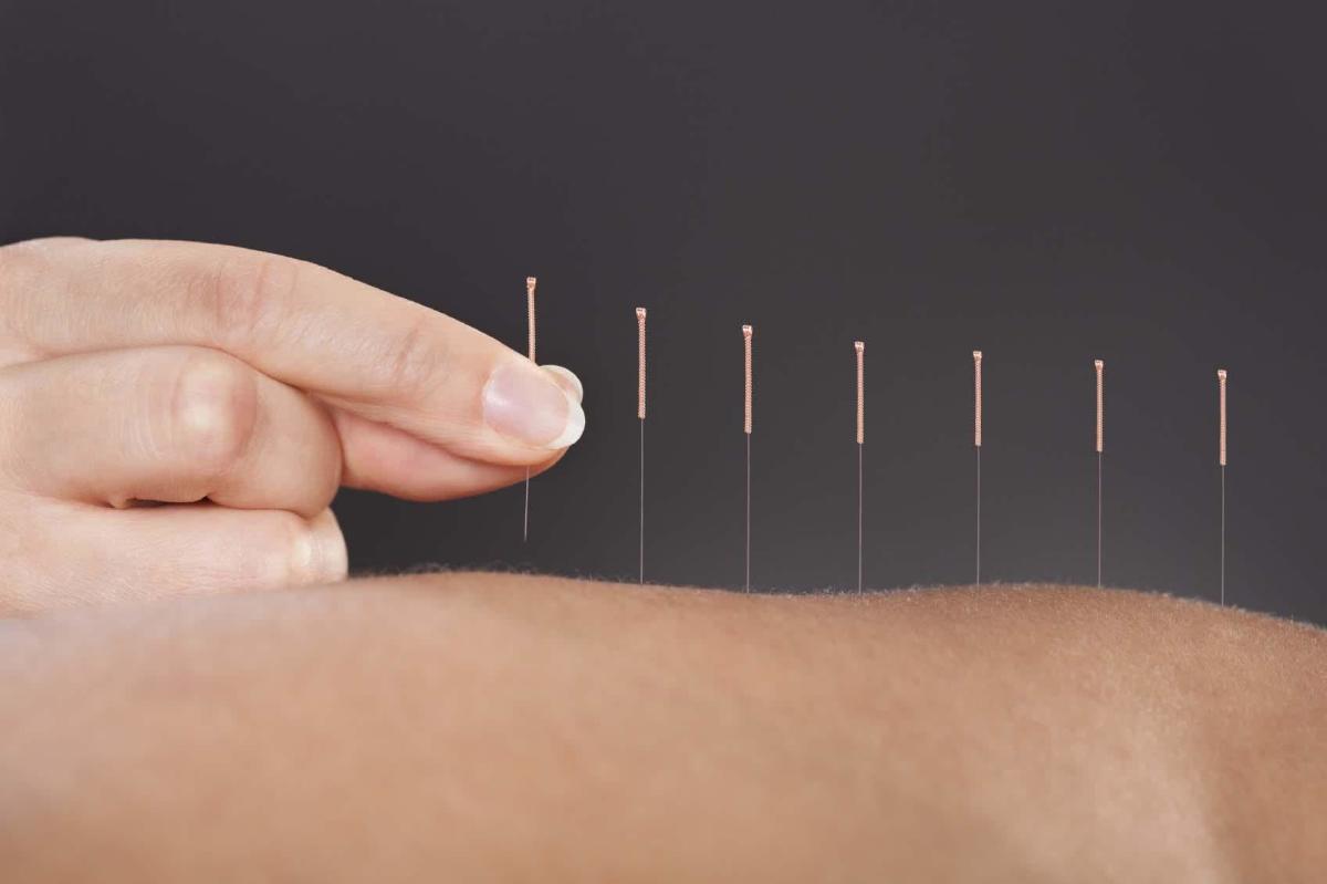 Médecine douce : quel remboursement pour l’acupuncture ?