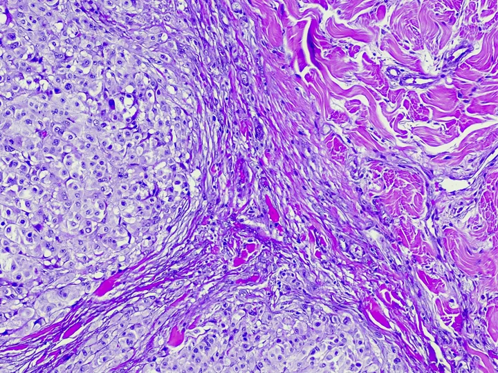 Cancer Cells under Microscope