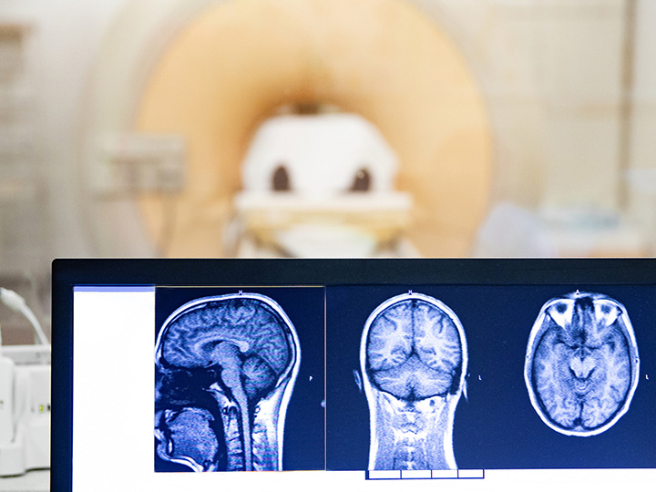 Brain scans of someone with epilepsy