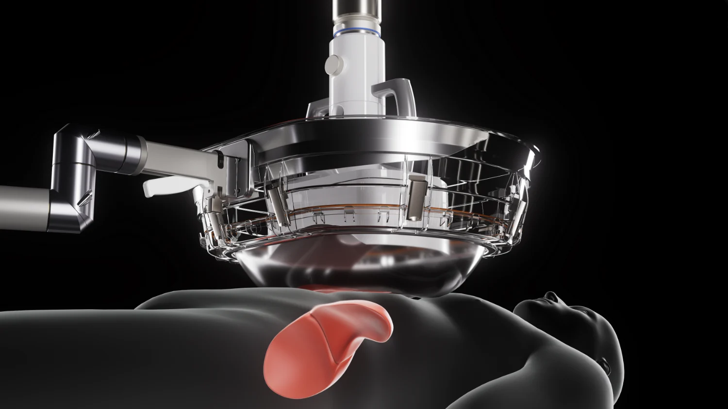 human figure with Histotripsy machine