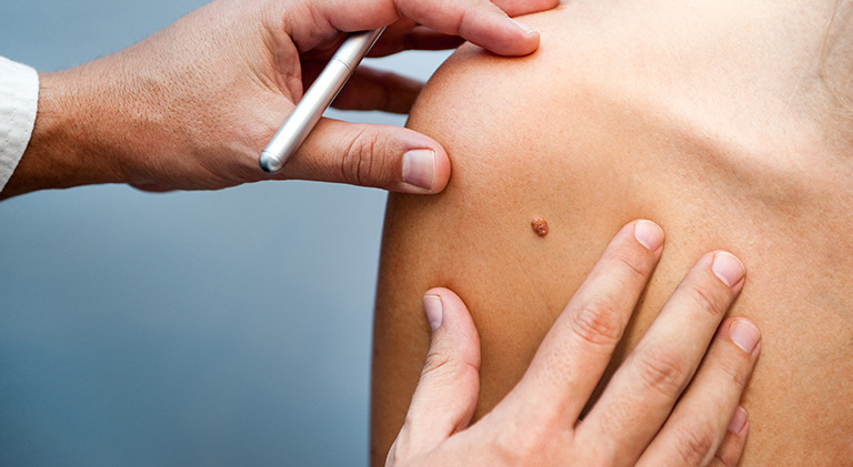 A doctor examines a potentially cancerous mole