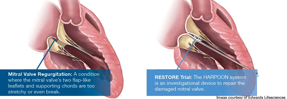 A diagram showing the procedure for mitral valve regurgitation