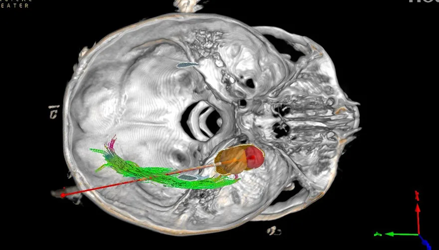 Epilepsy Ablation