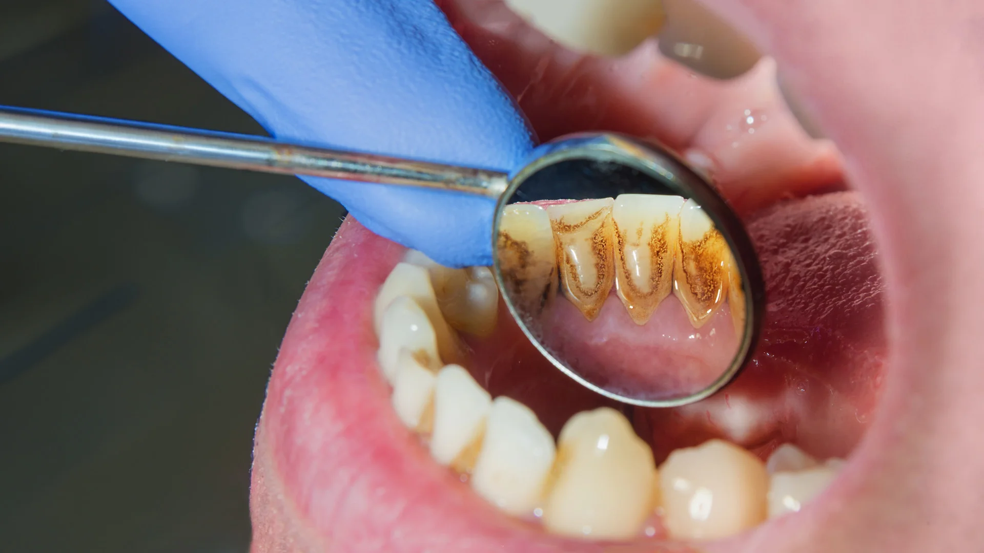 How to prevent tooth decay and cavities