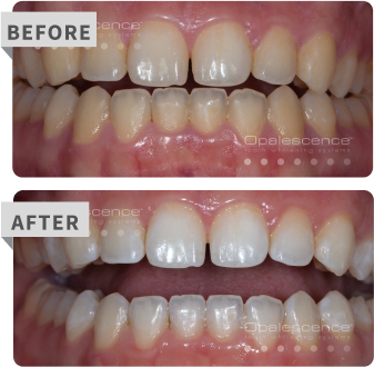 boost before after