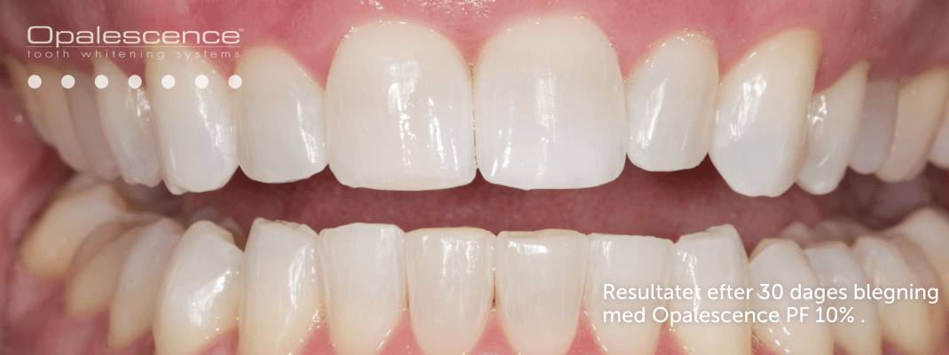 Efter tandblegning med Opalescence-systemet
