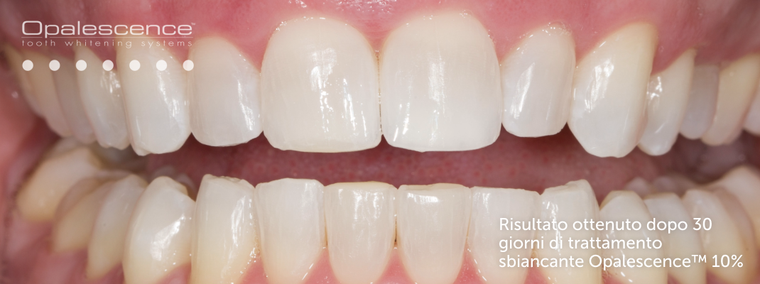 Dopo l'utilizzo del sistema di sbiancamento dentale Opalescence