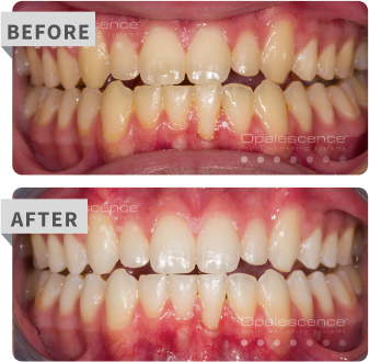 go before after