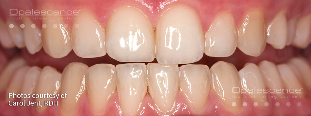 Before Opalescence tooth whitening system