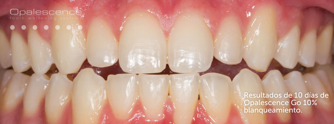 Después de Blanqueamiento Dental Opalescence