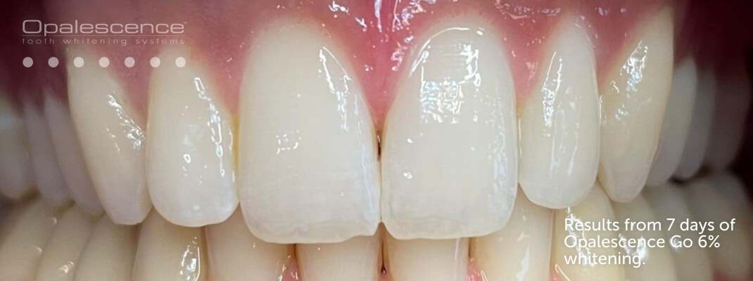 After Opalescence tooth whitening system