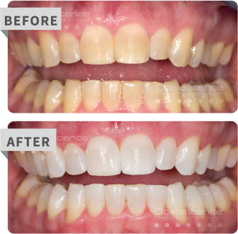 pf before after