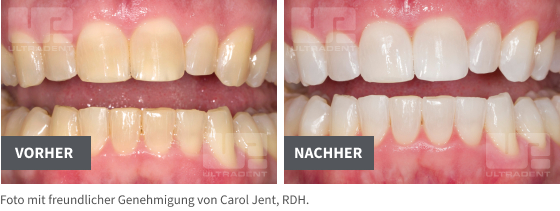 pf before/after