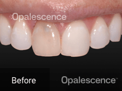 Before using Opalescence Endo