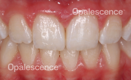 After Opalescence tooth whitening system