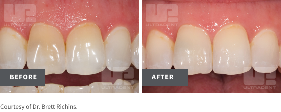 endo before/after