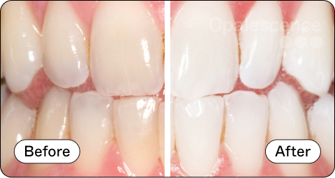 Opalescence Custom Whitening Before and After