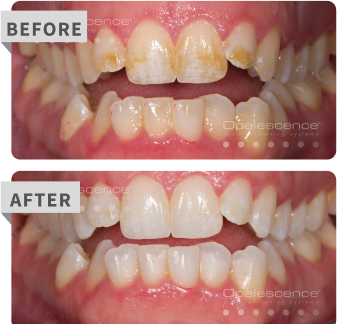pf before after