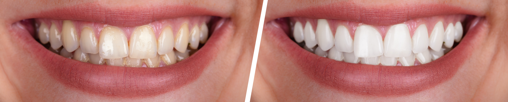 Teeth Whitening Process