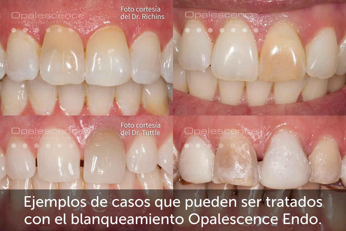 Dental Crown versus Dental Veneer