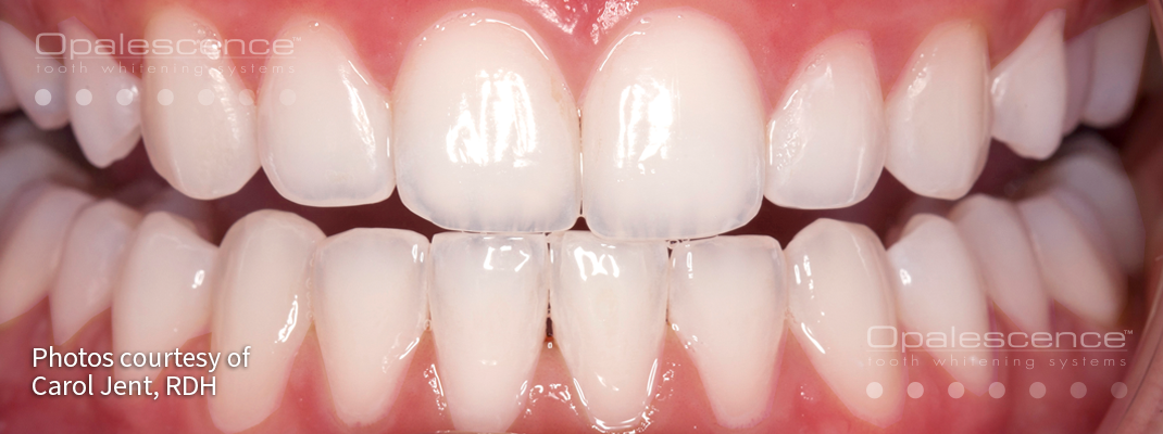 After Opalescence tooth whitening system