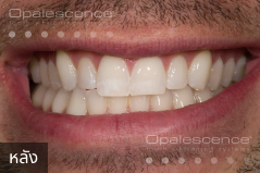 After using Opalescence Endo