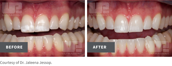 opalustre before/after