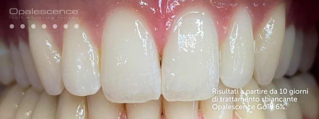 Dopo l'utilizzo del sistema di sbiancamento dentale Opalescence