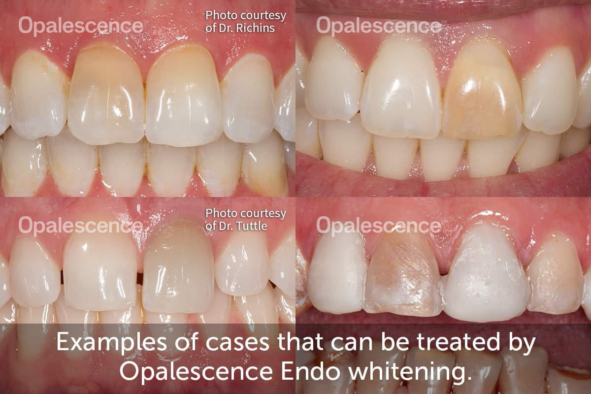 Dental Crown versus Dental Veneer