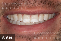Before using Opalescence Endo