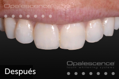 After using Opalescence Endo