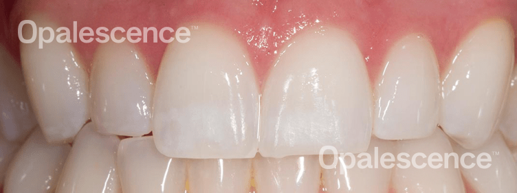 After Opalescence tooth whitening system