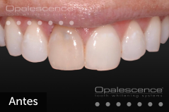 Before using Opalescence Endo