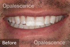 Before using Opalescence Endo