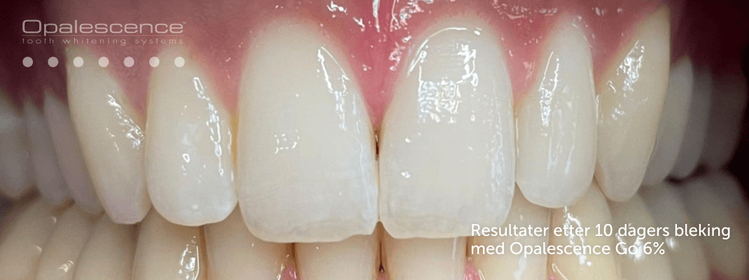 Etter Opalescence blekesystem