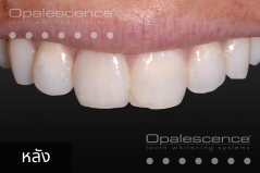 After using Opalescence Endo