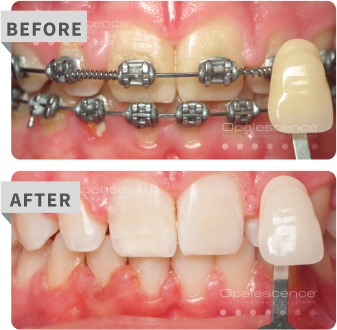 go before after