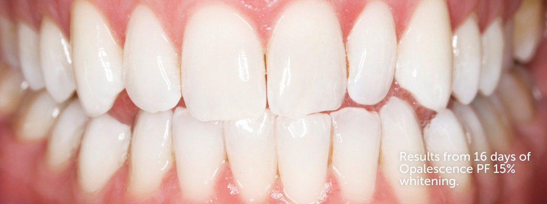 After Opalescence tooth whitening system