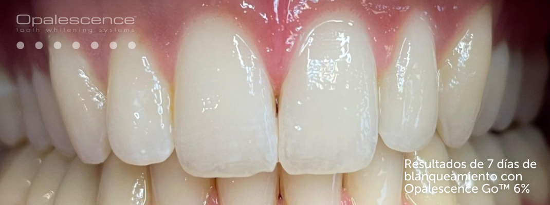 Después del sistema de blanqueamiento dental Opalescence