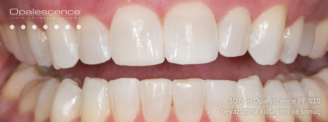 Opalescence diş beyazlatma sistemi sonrası