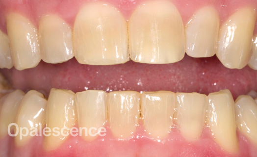 Before Opalescence tooth whitening system