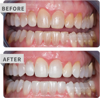 pf before after