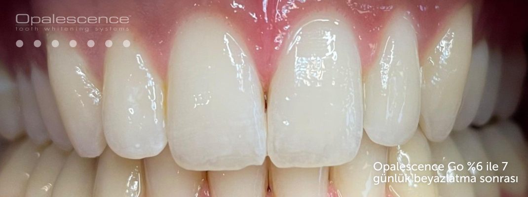 Opalescence diş beyazlatma sistemi sonrası