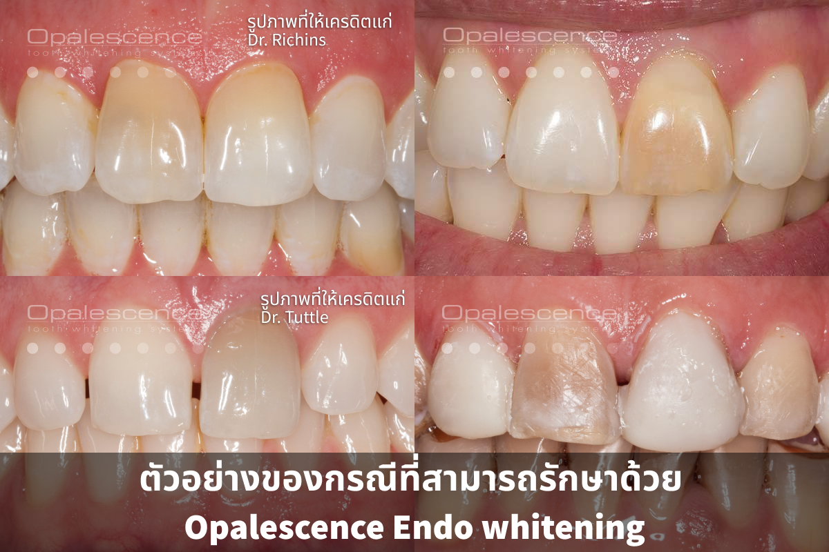 Dental Crown versus Dental Veneer