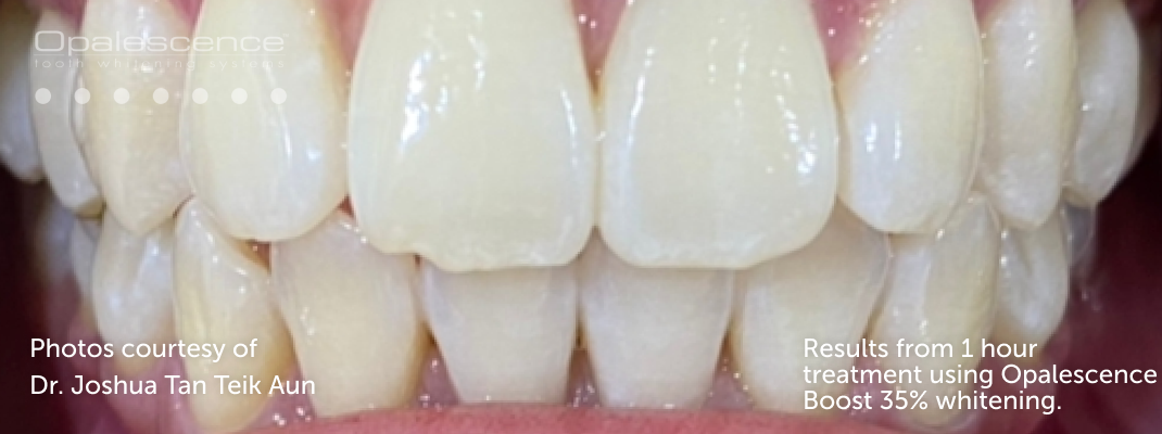 After Opalescence tooth whitening system